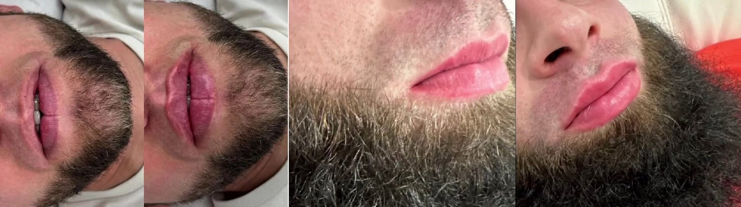 зачем кавказцы накачивают губы