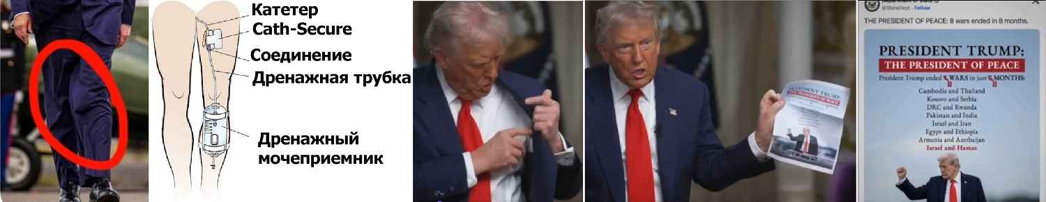 Трамп ходит с мочесборником